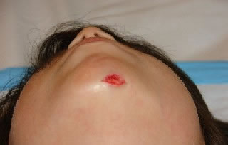 Laceration - Chin (After Skin Glue)