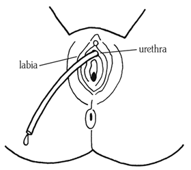 Akshar_Pediatrics_What is Clean Intermittent Catheterization? 5