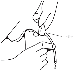 Akshar_Pediatrics_What is Clean Intermittent Catheterization? 7