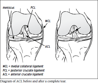 Akshar_Pediatrics_ACL Injuries (Care of the Young Athlete) 1