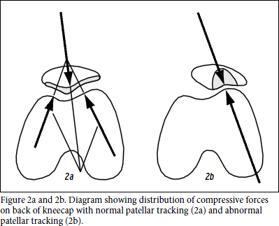 Akshar_Pediatrics_Patellofemoral Pain Syndrome (Care of the Young Athlete) 2